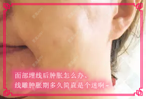 更美 - kris味苮女廖的埋线提升经验 | 北京 | 埋线提升