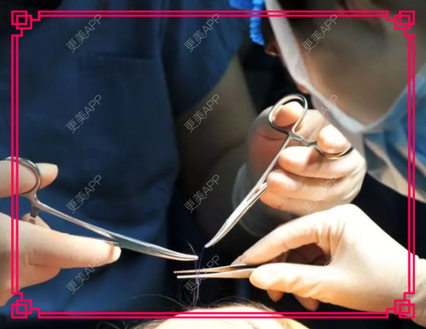 更美 - kris味苮女廖的埋线提升经验 | 北京 | 埋线提升