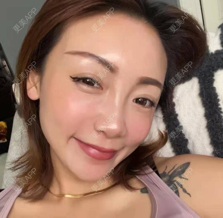 更美 - 更美用户pWocUiNkGM的激光淡斑经验 | 激光淡斑 | 上海