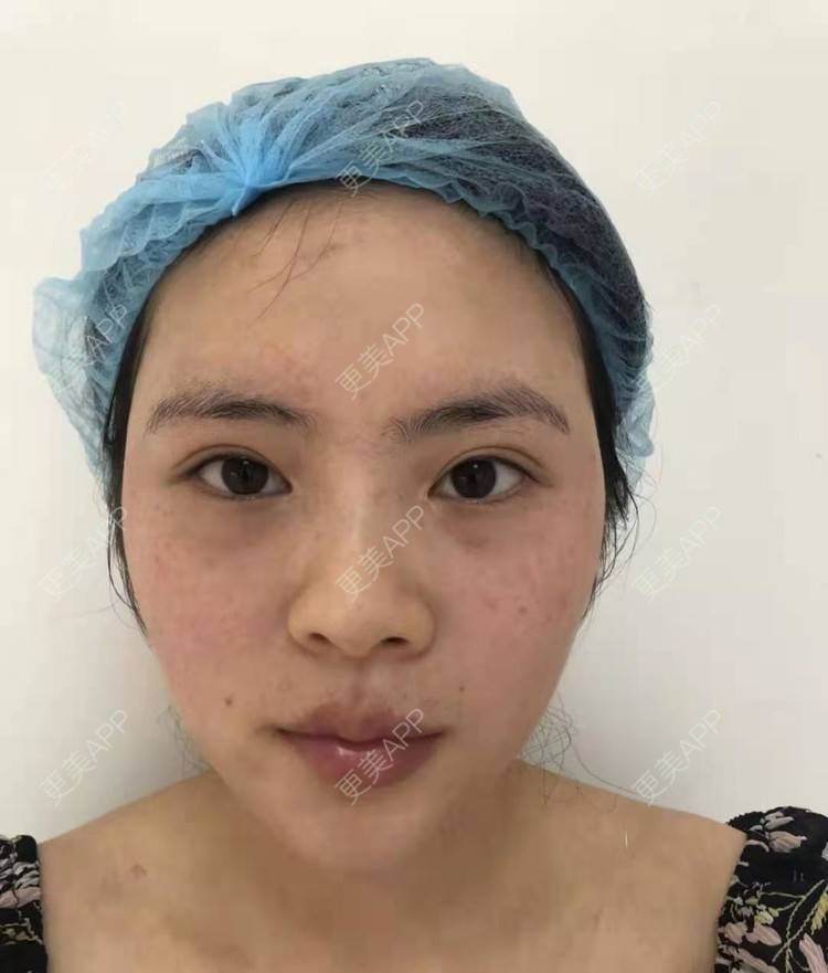 更美 - 更美用户pWocUiNkGM的激光淡斑经验 | 激光淡斑 | 上海