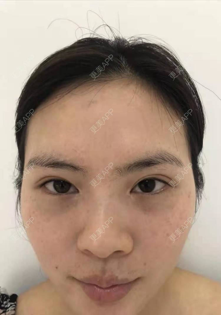 更美 - 更美用户pWocUiNkGM的激光淡斑经验 | 激光淡斑 | 上海
