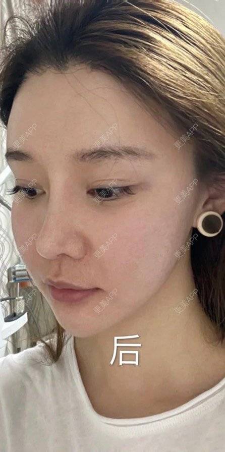 更美 - 更美用户hdm0W1zC2z的超声提升经验 | 超声提升 | 沈阳