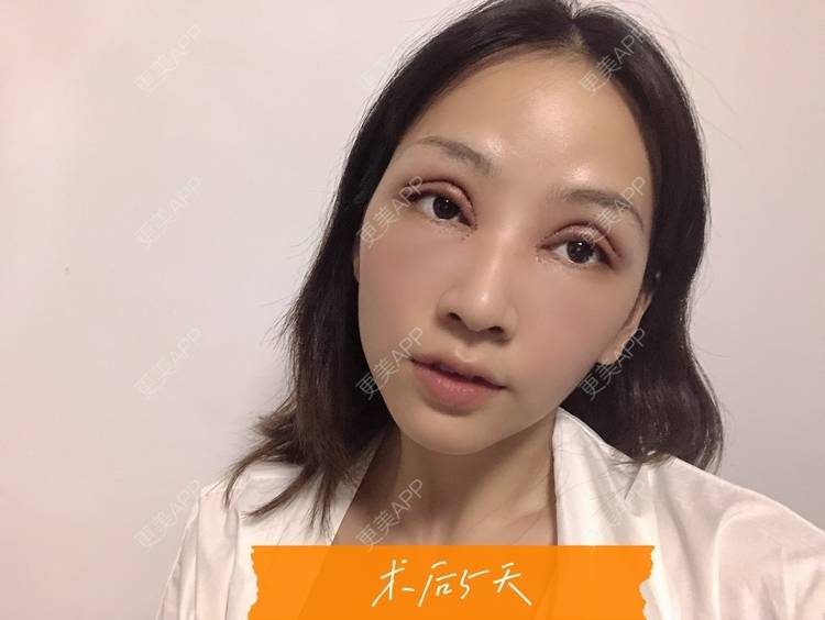 更美 - 韩盛斌 医生的双眼皮修复经验 | 双眼皮修复 | 开眼角修复 | 眼综合修复