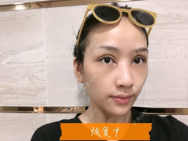 更美 - 韩盛斌 医生的双眼皮修复经验 | 双眼皮修复 | 开眼角修复 | 眼综合修复