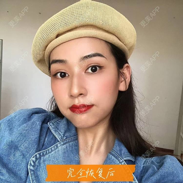 更美 - 韩盛斌 医生的双眼皮修复经验 | 双眼皮修复 | 开眼角修复 | 眼综合修复