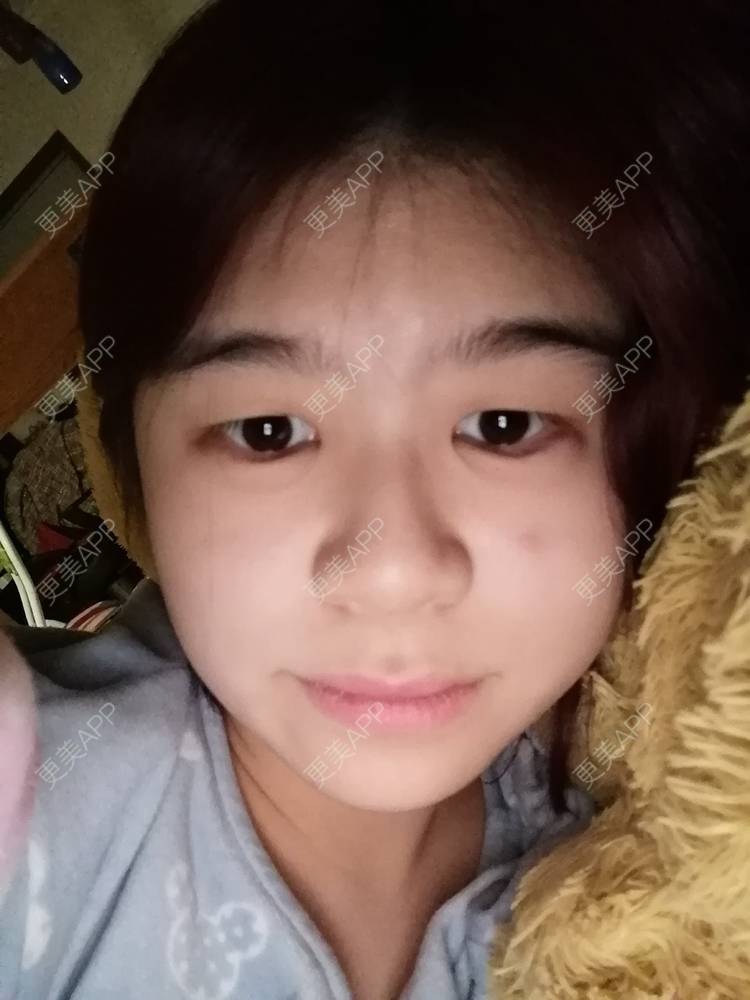 更美 - 一伊要变好看的玻尿酸卧蚕经验 | 玻尿酸卧蚕 | 玻尿酸唇部 | 玻尿酸泪沟 | 北京