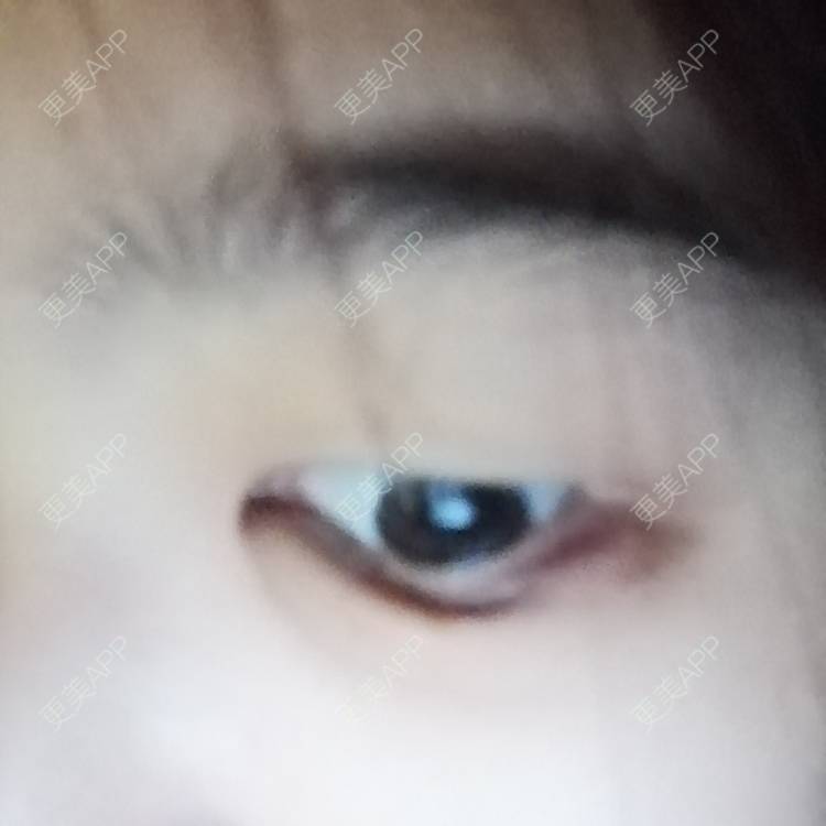 更美 - 一伊要变好看的玻尿酸卧蚕经验 | 玻尿酸卧蚕 | 玻尿酸唇部 | 玻尿酸泪沟 | 北京