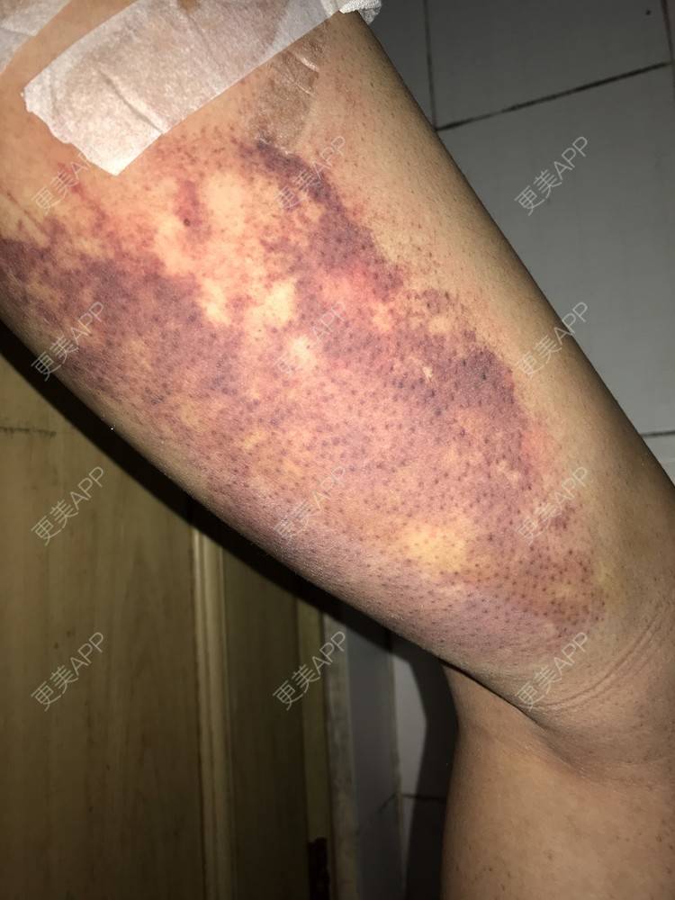 更美 - •你的小可爱•的自体脂肪垫下巴经验 | 自体脂肪垫下巴 | 自体脂肪丰太阳穴 | 深圳 | 自体脂肪垫鼻基底 | 玻尿酸溶解酶