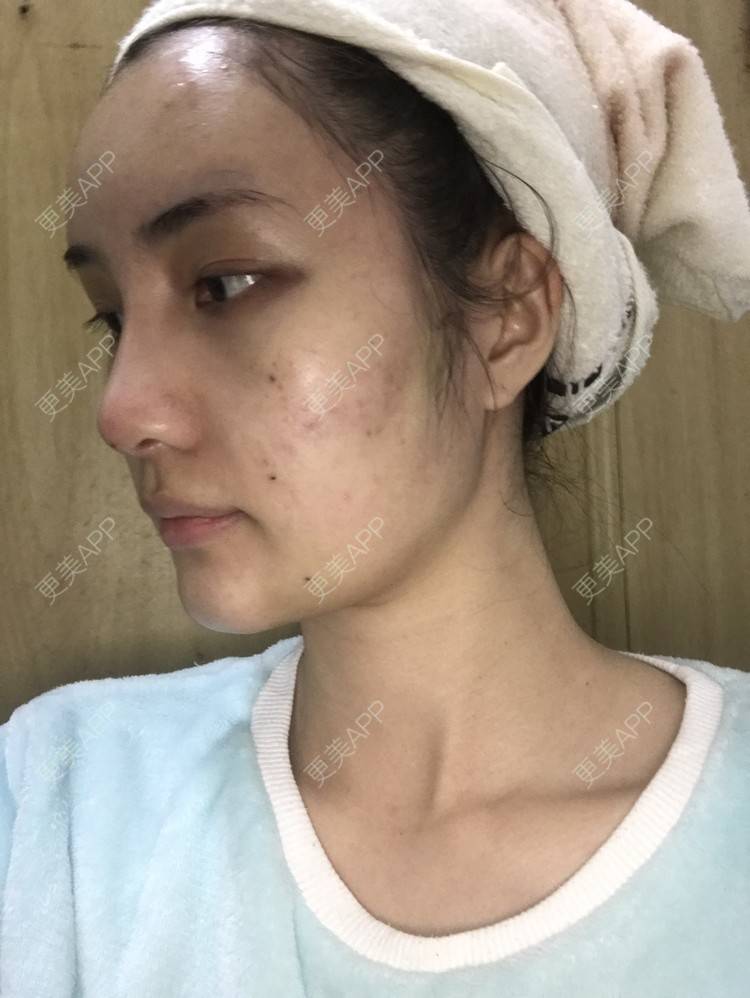 更美 - •你的小可爱•的自体脂肪垫下巴经验 | 自体脂肪垫下巴 | 自体脂肪丰太阳穴 | 深圳 | 自体脂肪垫鼻基底 | 玻尿酸溶解酶