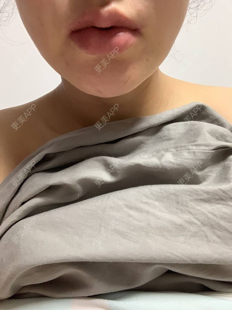 更美 - 更美用户SM4dtJKhse的厚唇改薄经验 | 厚唇改薄 | 蚌埠 | 微笑唇手术
