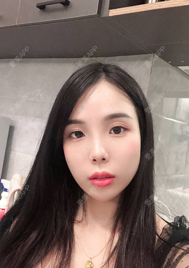 更美 - 更美用户R6T7237QNx的硅胶垫下巴经验 | 视频日记 | 硅胶垫下巴 | 深圳