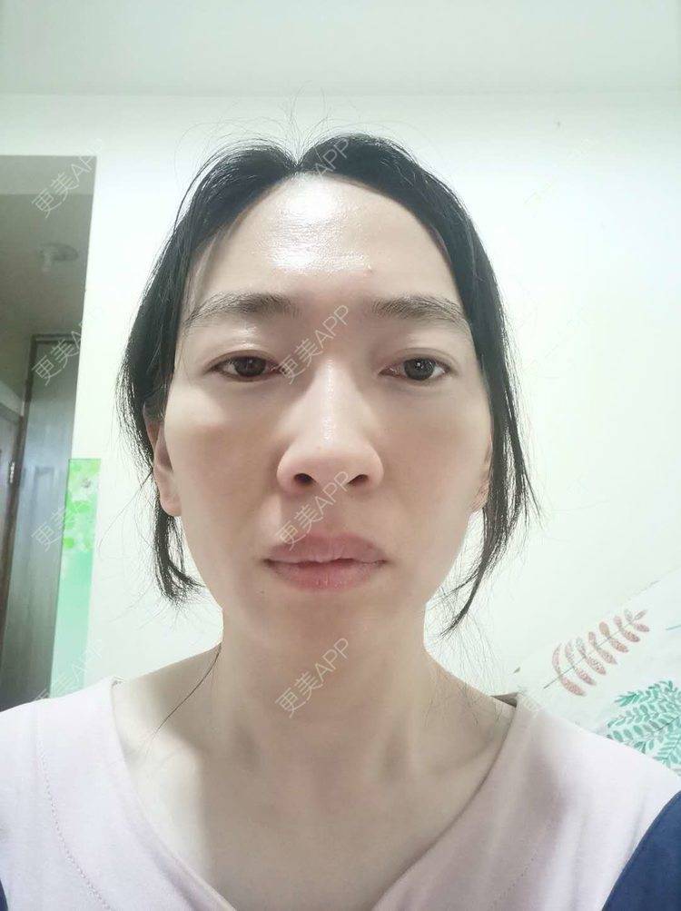 更美 - 更美用户pBooEW0d36的激光去眼袋经验 | 北京 | 激光去眼袋