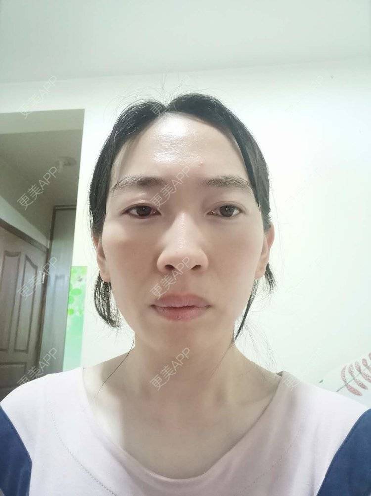 更美 - 更美用户pBooEW0d36的激光去眼袋经验 | 北京 | 激光去眼袋