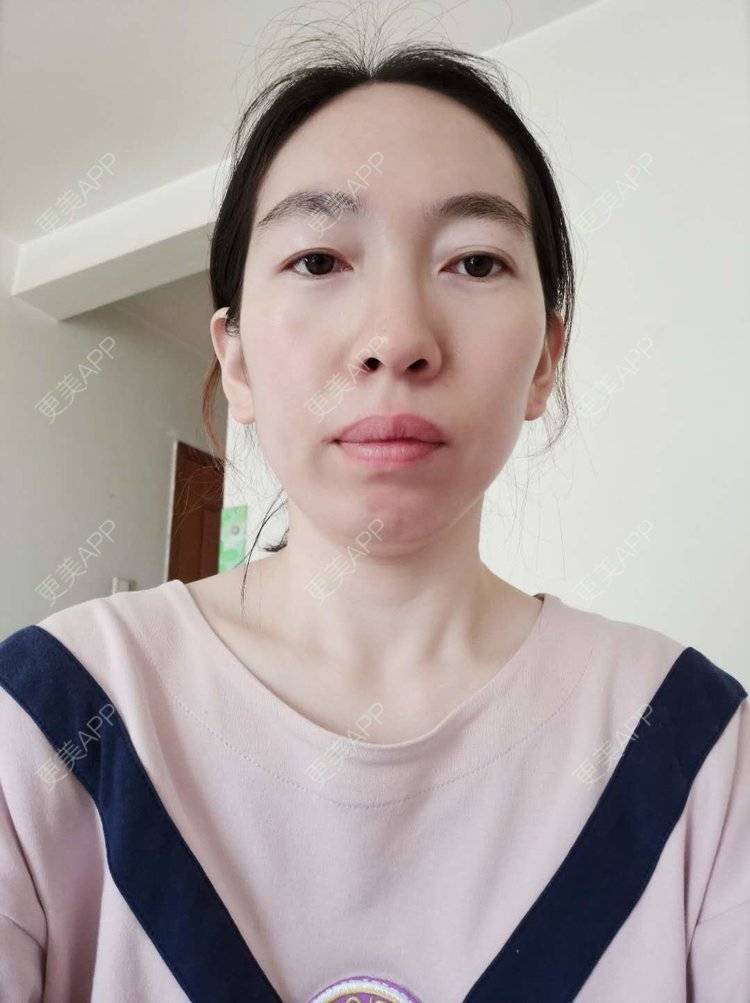 更美 - 更美用户pBooEW0d36的激光去眼袋经验 | 北京 | 激光去眼袋