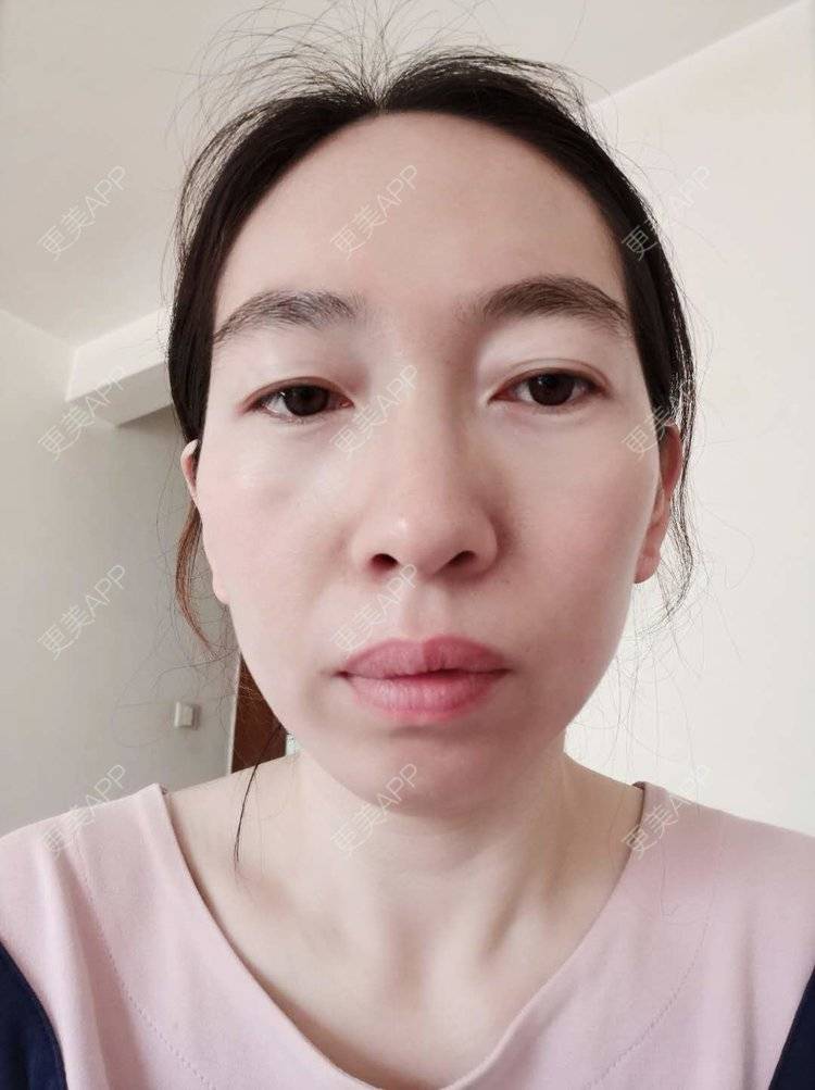 更美 - 更美用户pBooEW0d36的激光去眼袋经验 | 北京 | 激光去眼袋