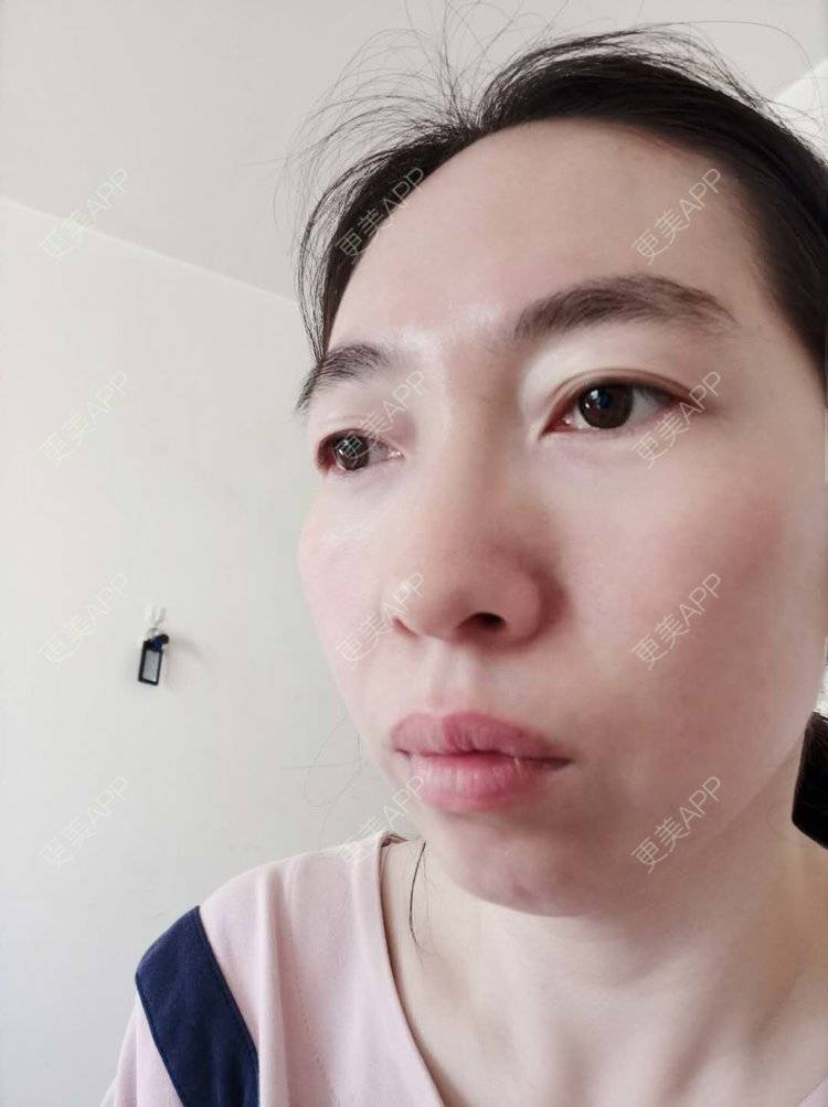 更美 - 更美用户pBooEW0d36的激光去眼袋经验 | 北京 | 激光去眼袋