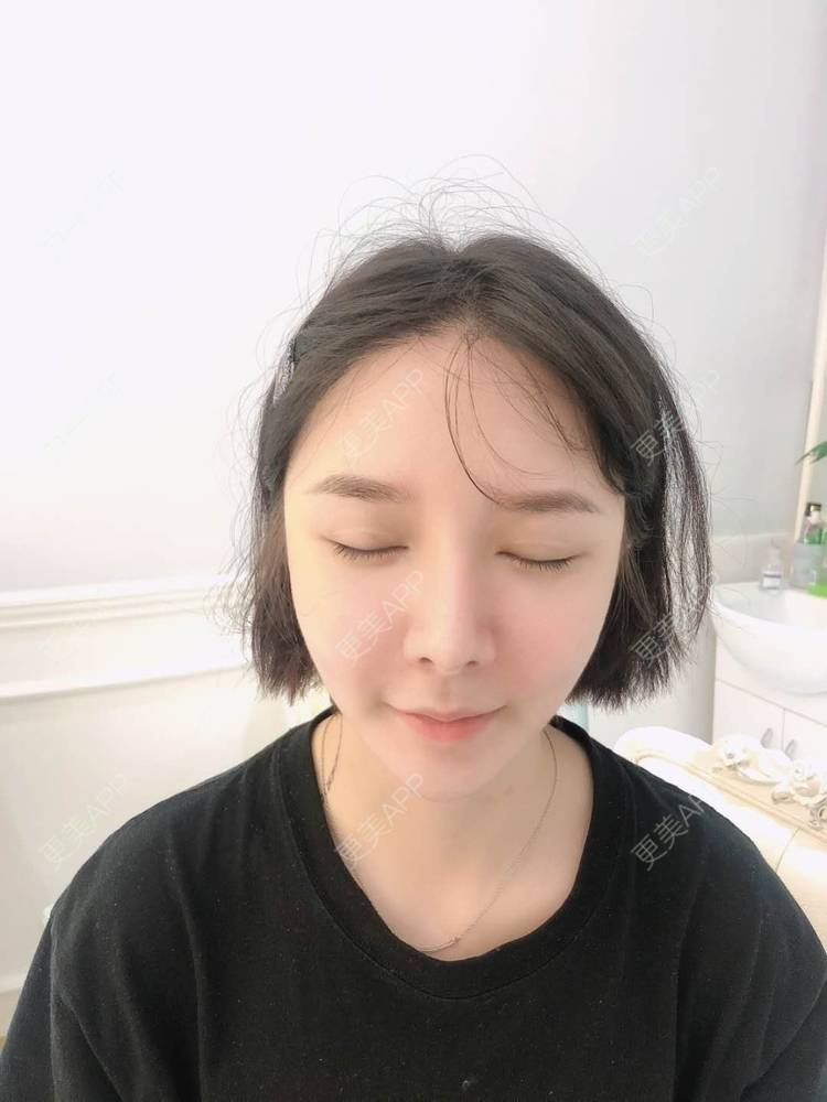 更美 - 榕榕路的自体脂肪丰苹果肌经验 | 自体脂肪丰苹果肌 | 深圳 | 自体脂肪全面部填充