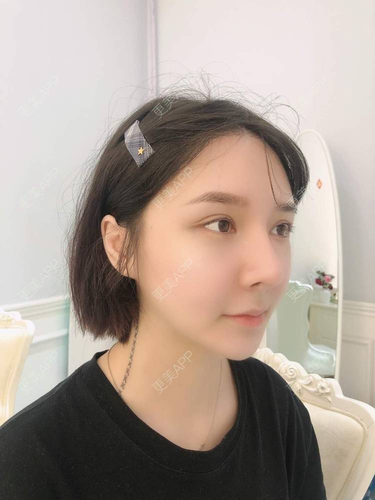 更美 - 榕榕路的自体脂肪丰苹果肌经验 | 自体脂肪丰苹果肌 | 深圳 | 自体脂肪全面部填充