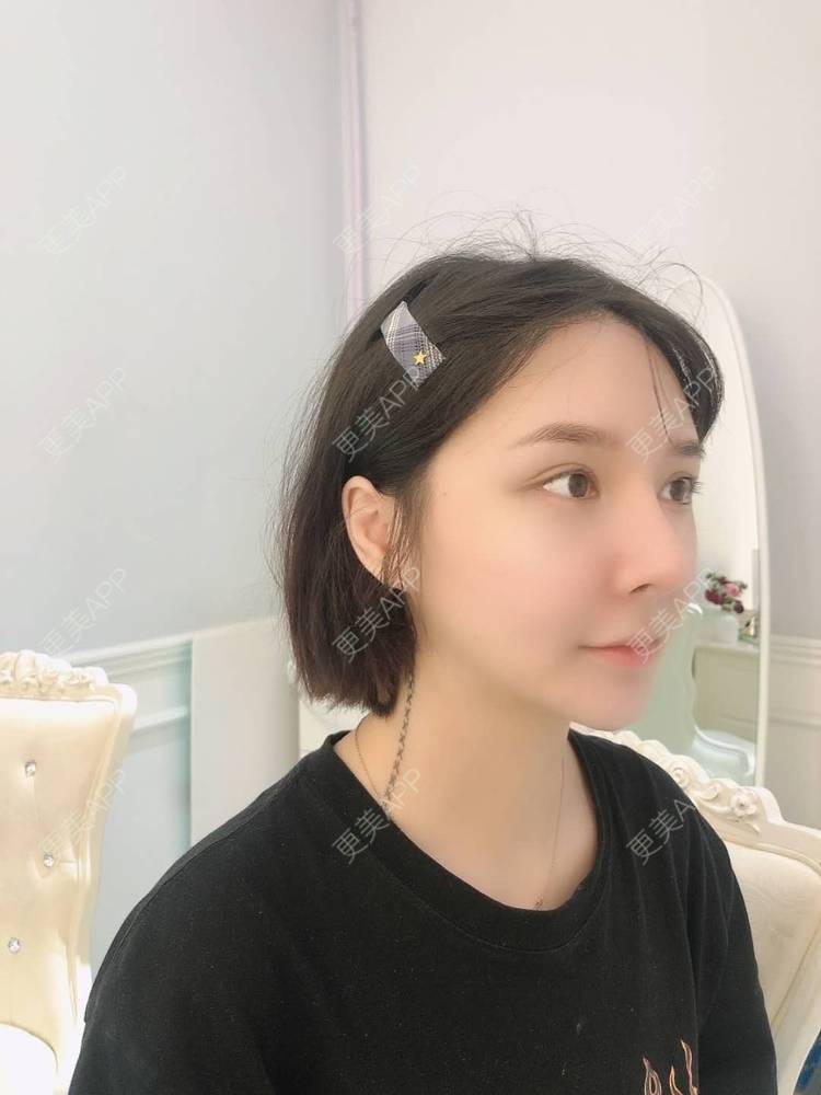 更美 - 榕榕路的自体脂肪丰苹果肌经验 | 自体脂肪丰苹果肌 | 深圳 | 自体脂肪全面部填充