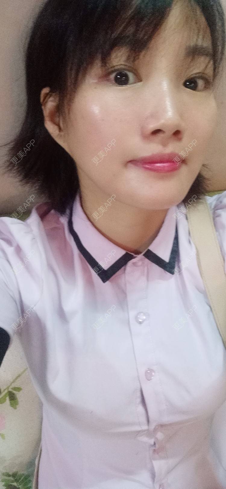 更美 - 姐妹花穿的热玛吉经验 | 深圳 | 热玛吉 | 超声提升 | 埋线提升 | 拉皮 | 小切口手术提升