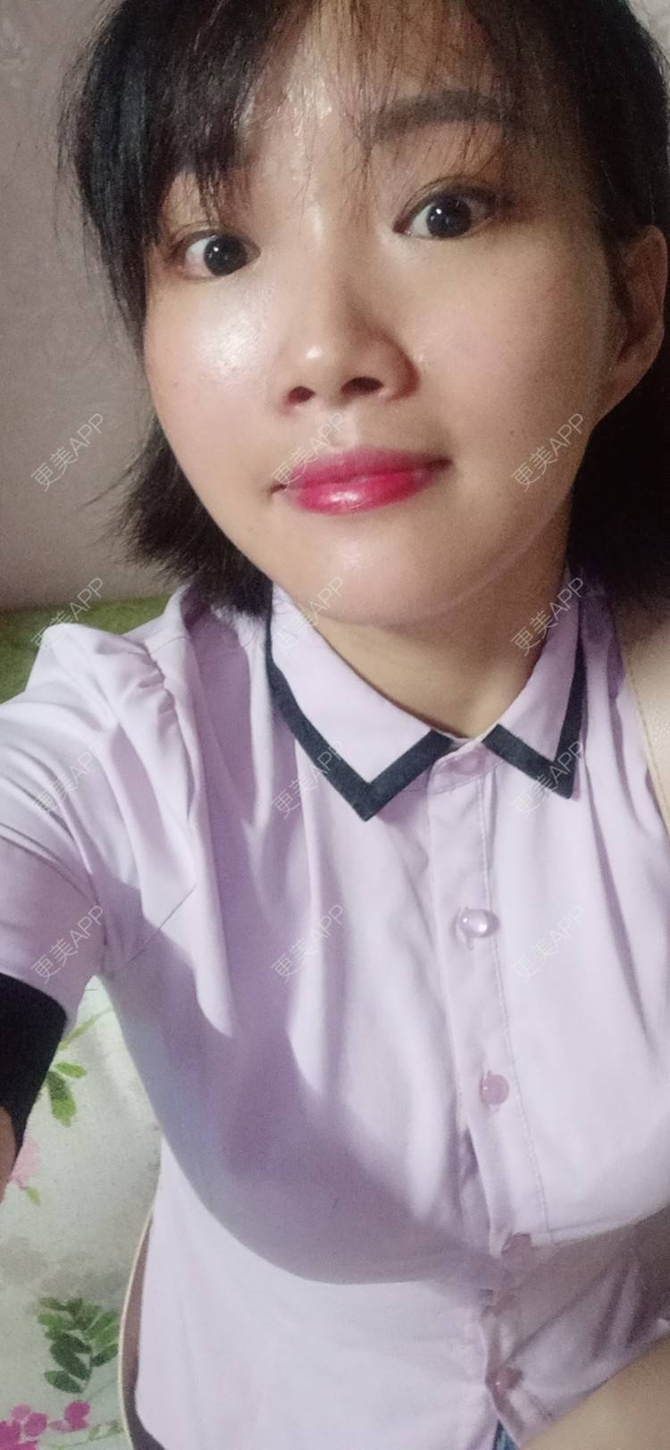 更美 - 姐妹花穿的热玛吉经验 | 深圳 | 热玛吉 | 超声提升 | 埋线提升 | 拉皮 | 小切口手术提升