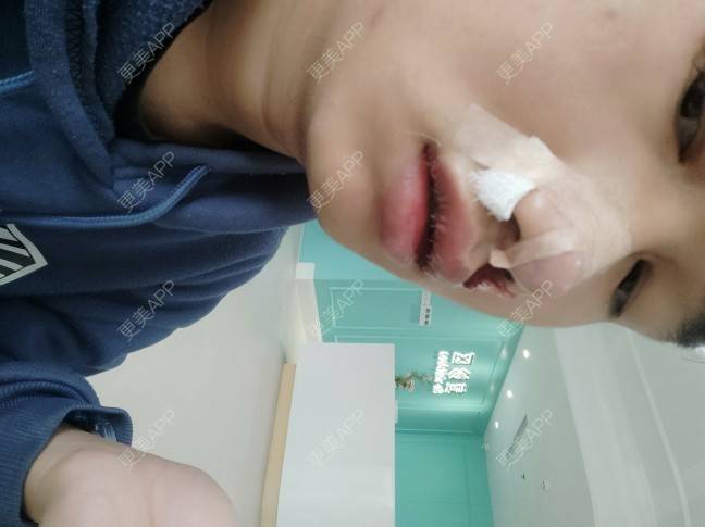 更美 - 更美用户Dc0uLvMdeZ的手术缩鼻头经验 | 手术缩鼻头 | 鼻翼缩小 | 佛山