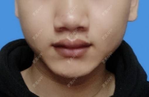 更美 - 更美用户Dc0uLvMdeZ的手术缩鼻头经验 | 佛山 | 手术缩鼻头 | 鼻翼缩小