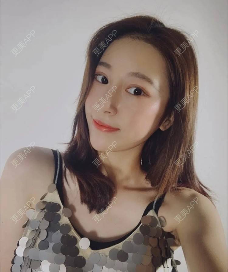 更美 - 更美用户zYNzGjUTke的玻尿酸卧蚕经验 | 玻尿酸卧蚕 | 杭州