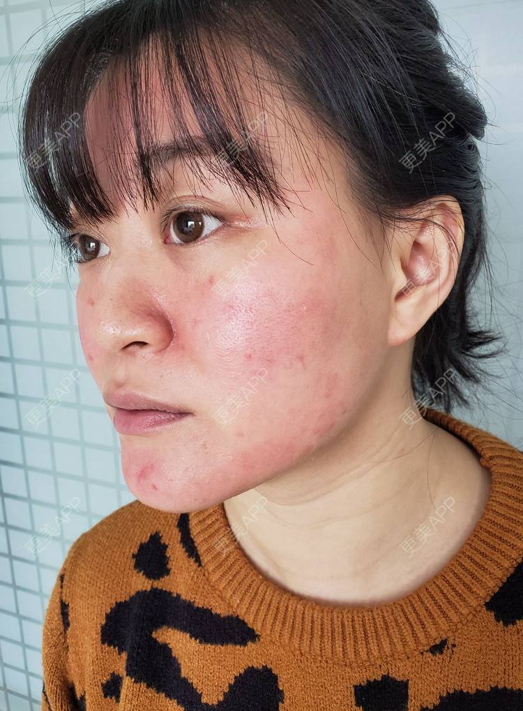 更美 - 蒹葭青衫瓢的红蓝光清痘经验 | 红蓝光清痘 | 祛疤痕痘印 | 皮肤检测 | 成都