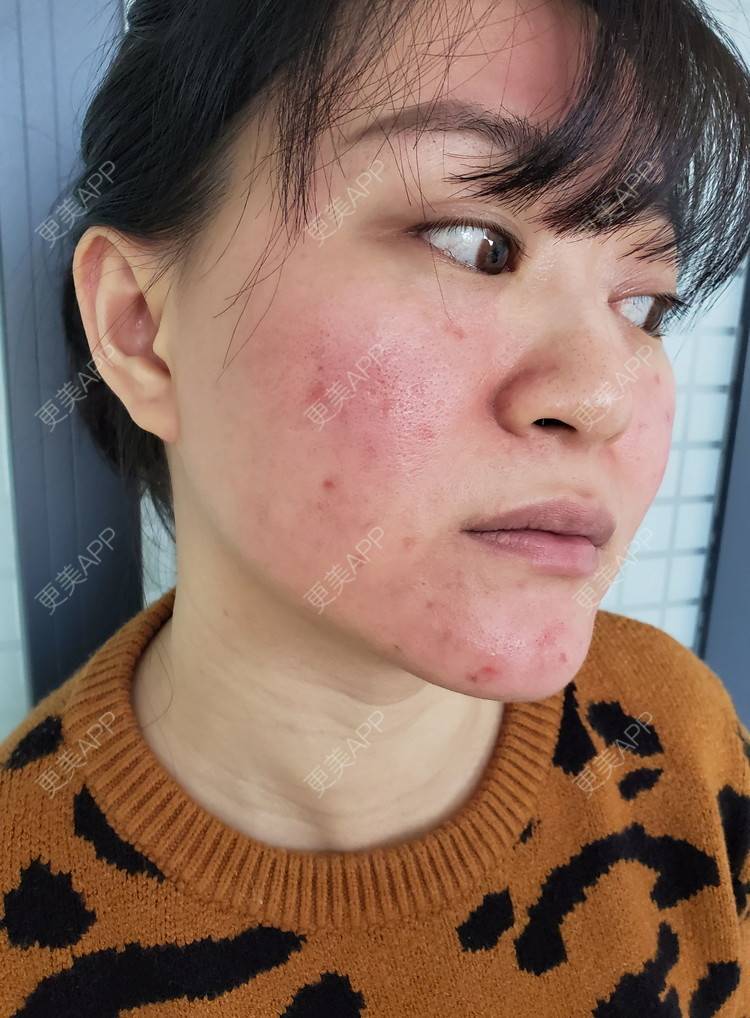更美 - 蒹葭青衫瓢的红蓝光清痘经验 | 红蓝光清痘 | 祛疤痕痘印 | 皮肤检测 | 成都