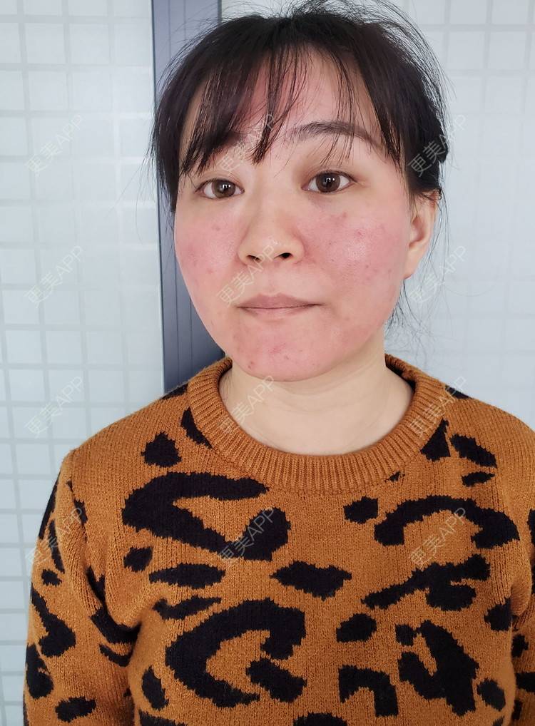 更美 - 蒹葭青衫瓢的红蓝光清痘经验 | 红蓝光清痘 | 祛疤痕痘印 | 皮肤检测 | 成都