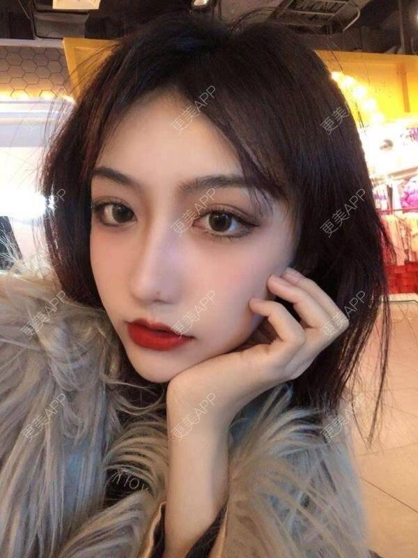 更美 - 更美用户vyGZmGiYhV的隆鼻经验 | 耳软骨隆鼻 | 肋软骨隆鼻 | 鼻翼缩小 | 鼻小柱延长 | 鼻部多项 | 隆鼻 | 重庆 | 鼻中隔软骨隆鼻 | 鼻基底 | 自体肋软骨垫鼻基底