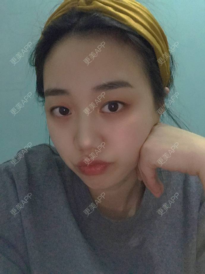 更美 - 更美用户M7wYKqrvfh的玻尿酸法令纹经验 | 玻尿酸法令纹 | 上海
