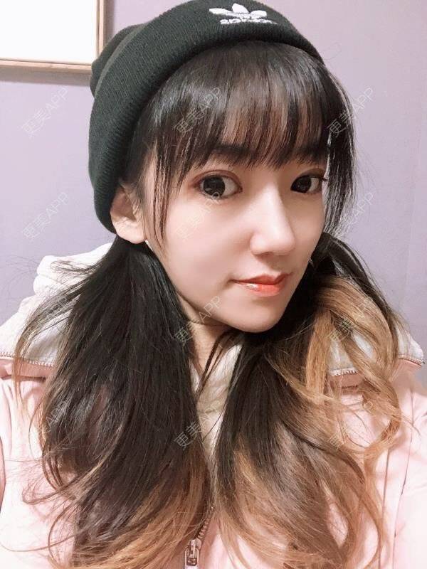 更美 - 更美用户wblpvf6bo1的鼻部多项经验 | 肋软骨隆鼻 | 鼻翼缩小 | 鼻小柱延长 | 鼻部多项 | 自体肋软骨垫鼻基底 | 重庆 | 假体垫鼻基底 | 鼻中隔软骨隆鼻