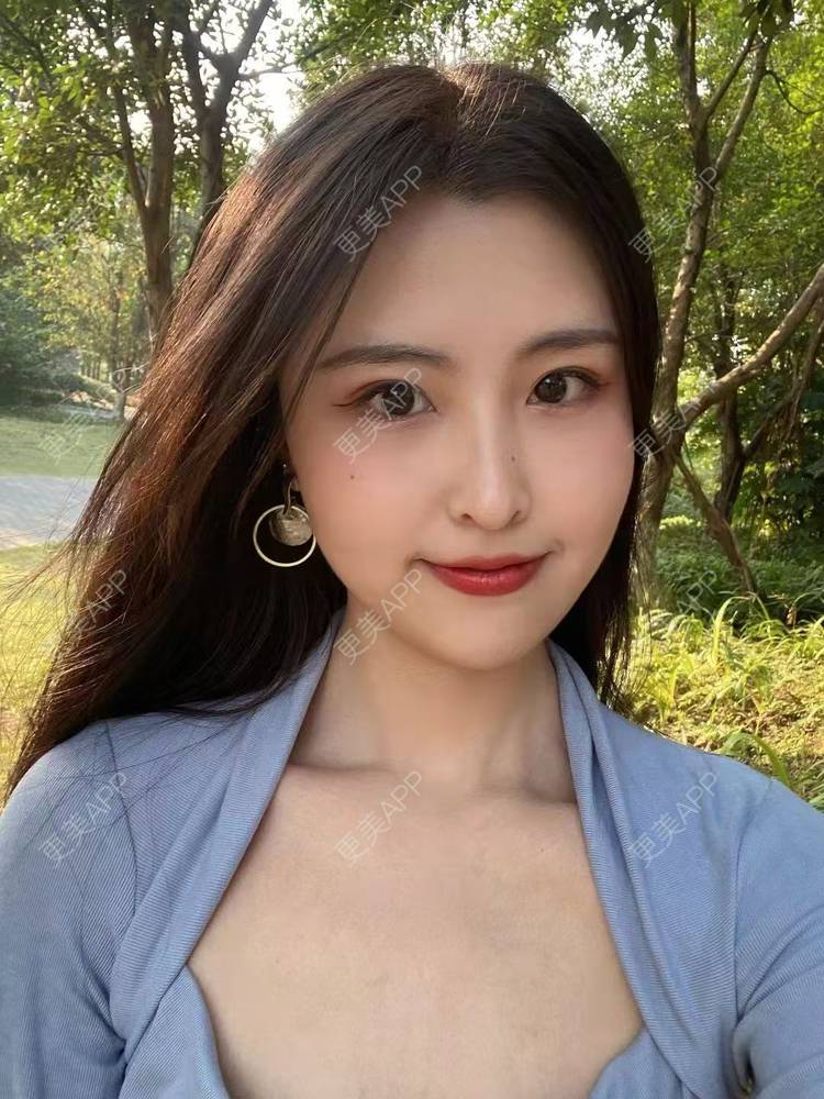 更美 - 温茹暖风的自体脂肪填充泪沟经验 | 自体脂肪填充泪沟