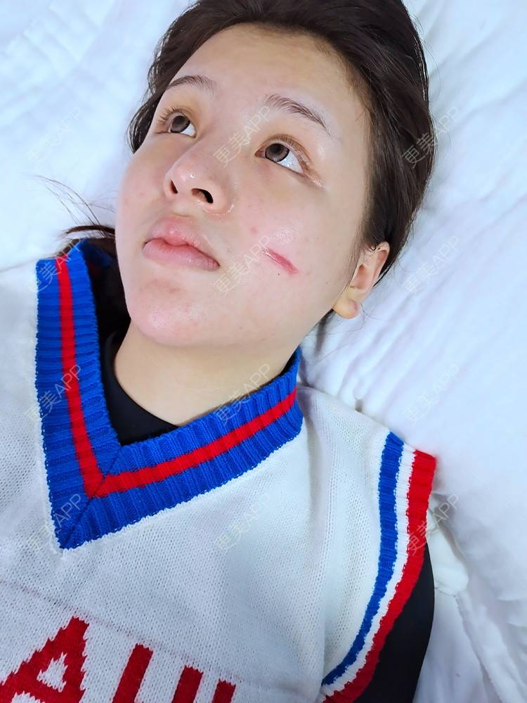 更美 - 更美用户8toXV2FXyZ的激光淡疤经验 | 皮肤综合管理套餐 | 祛疤痕痘印 | 激光淡疤 | 成都