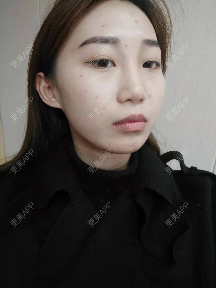 更美 - 更美用户4qTzIrQeRG的红蓝光清痘经验 | 红蓝光清痘 | 祛疤痕痘印 | 皮肤综合管理套餐 | 成都
