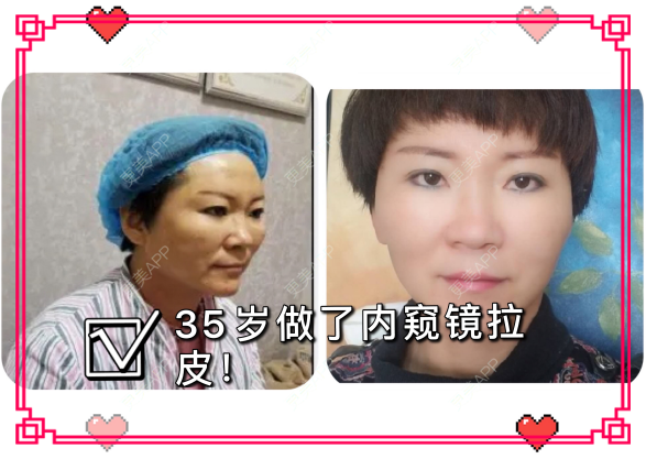 更美 - 更美用户issoWkJiGy的拉皮经验 | 白银 | 拉皮