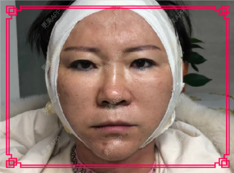 更美 - 更美用户issoWkJiGy的拉皮经验 | 白银 | 拉皮