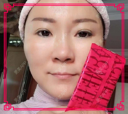 更美 - 更美用户issoWkJiGy的拉皮经验 | 白银 | 拉皮