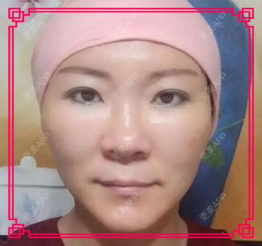 更美 - 更美用户issoWkJiGy的拉皮经验 | 白银 | 拉皮