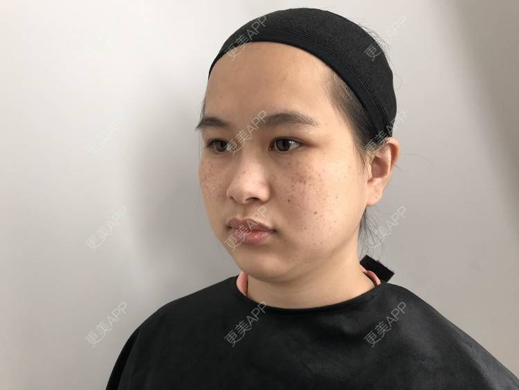 更美 - 更美用户mPNLZyEd3H的点阵激光经验 | 点阵激光