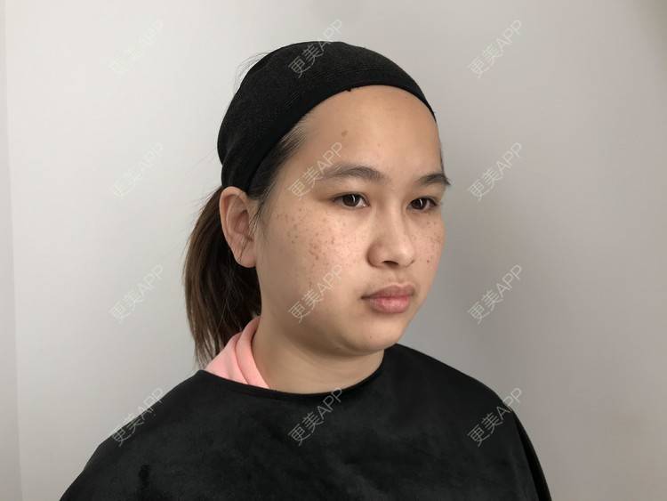 更美 - 更美用户mPNLZyEd3H的点阵激光经验 | 点阵激光