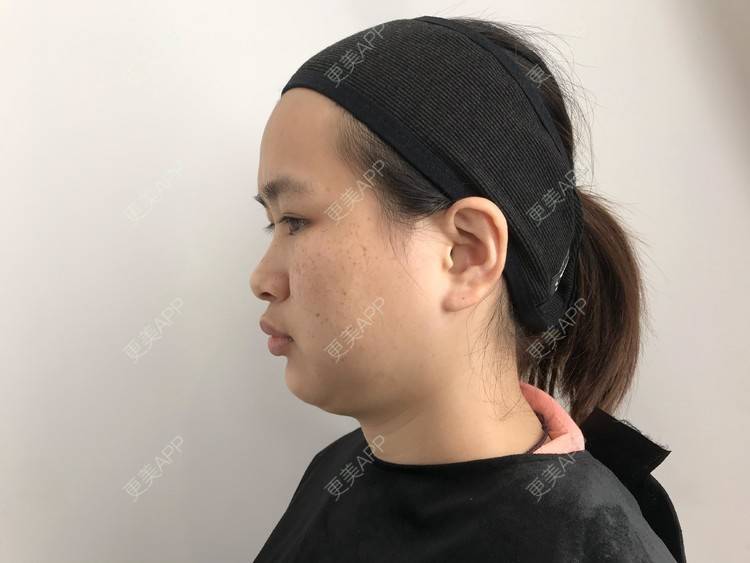 更美 - 更美用户mPNLZyEd3H的点阵激光经验 | 点阵激光