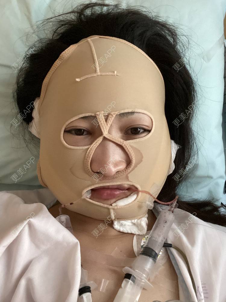 失意花季少女ヰ晒的下颌角切除术日记