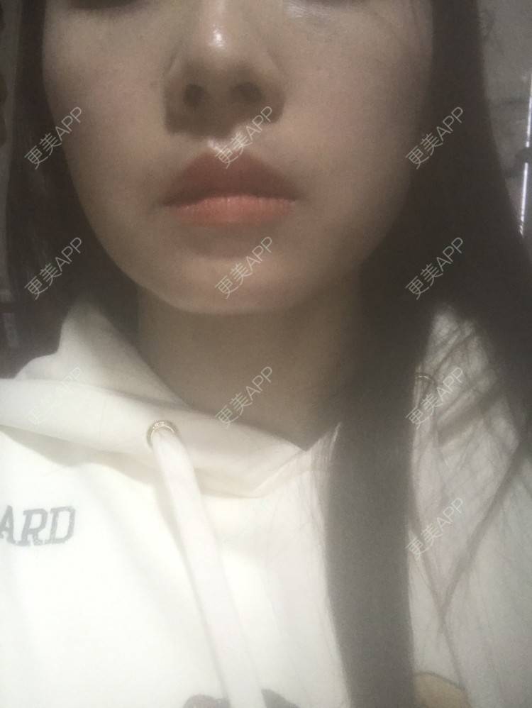 更美 - 🌈J Nail🌤的除皱瘦脸经验 | 除皱瘦脸 | 成都