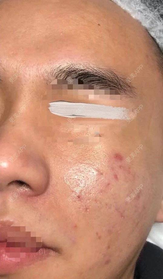 更美 - 更美用户7XGlnjvrvL的黄金微针经验 | 黄金微针 | 沈阳