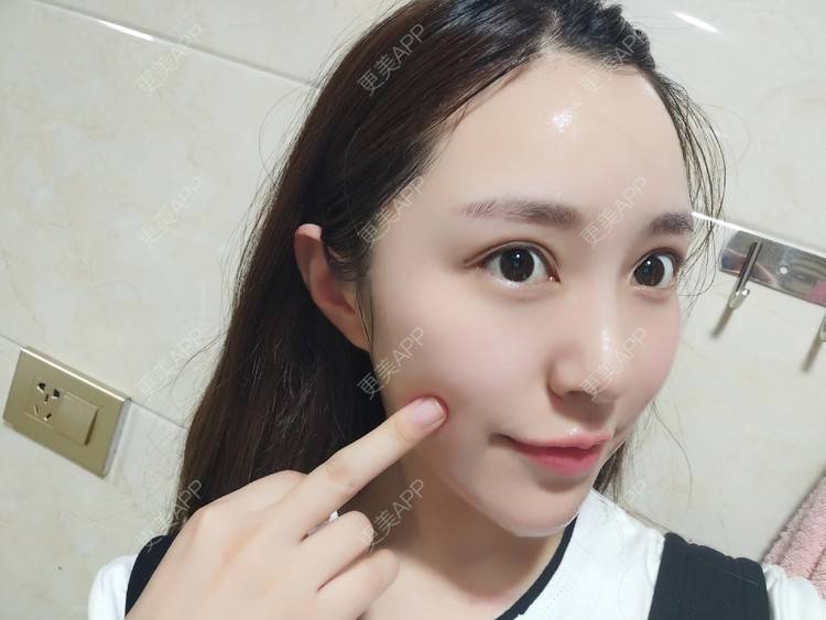 更美 - 更美用户TIxx2z1nYV的埋线双眼皮经验 | 埋线双眼皮 | 郑州
