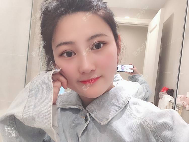 更美 - 软兔є(･◇･｡)э的埋线双眼皮经验 | 埋线双眼皮 | 视频日记 | 武汉