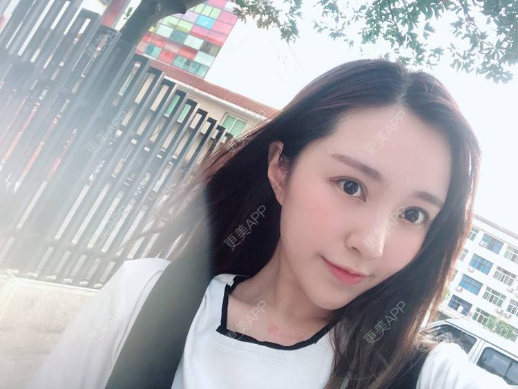 更美 - 更美用户TIxx2z1nYV的埋线双眼皮经验 | 埋线双眼皮 | 郑州